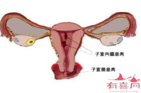 子宫内膜息肉是否影响排卵？