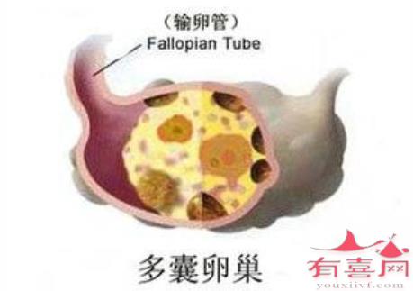 南京借卵生子：患有多囊卵巢容易生孩子吗？